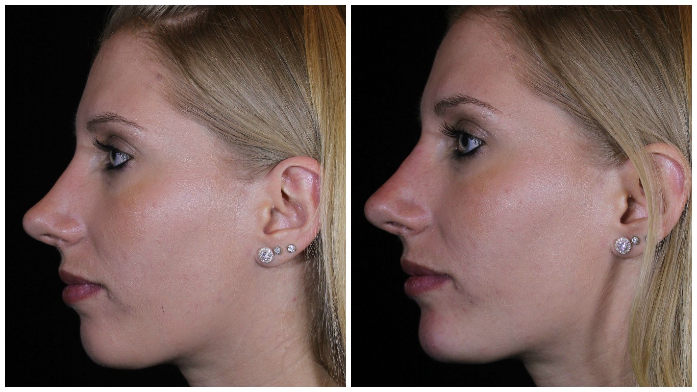 How Your Rhinoplasty Changes with Age: Factors That Affect Results post thumbnail image
