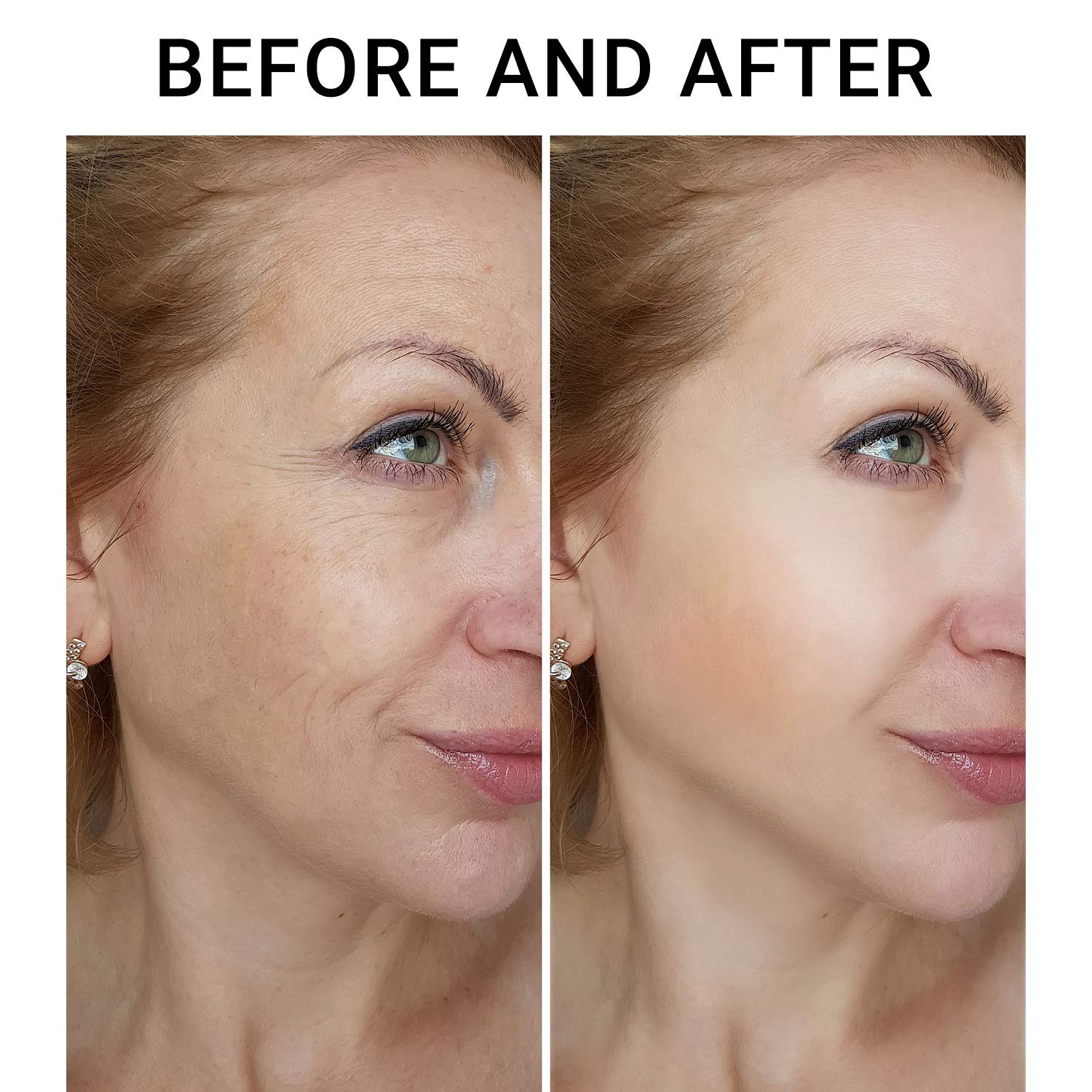 What is a face lifting procedure? post thumbnail image