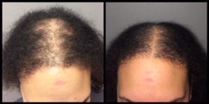 How the Fotona Laser Can Improve Your Hair Growth post thumbnail image