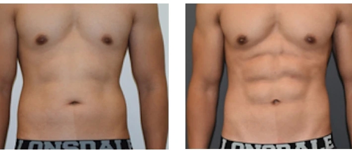 Liposuction (ดูดไขมัน) is actually a medical procedure post thumbnail image